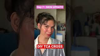 Day 7 Skin Update  DIY TCA CROSS  Acne Scars Treatment [upl. by Elberta244]