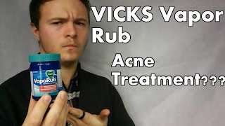 VICKS Vapor Rub ACNE TREATMENT GOOD PRODUCT FOR TEENS When Where amp How To Apply [upl. by Ahsinert653]