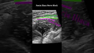 Fascia Iliaca Plane Block ultrasound nerveblock anatomy [upl. by Lammond]