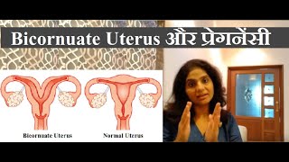 Bicornuate Uterus एक ठोस वजह गर्भ धारण न होने की  Bicornuate Uterus Treatment [upl. by Trinee]