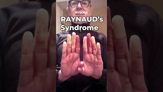 Epinephrine in Raynauds Syndrome raynauds syndrome epinephrine nysora anesthesia [upl. by Nnalyrehs]