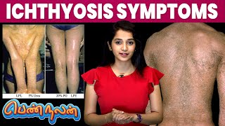 Ichthyosis நோய்யின் Symptoms இது தான்  Remedies For Ichthyosis  Pen Nalan  IBC Mangai [upl. by Kylander]