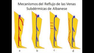 Ecodoppler color  Insuficiencia venosa  Escleroterapia  Mayo 2016 [upl. by Krystyna694]