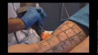 Thermage pour traiter la cellulite [upl. by Mariand]