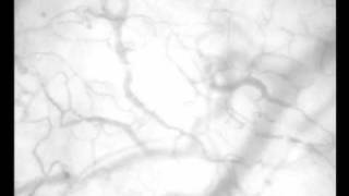 Microvascular Flow in Leukocytosis before and after Treatment [upl. by Win]