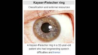 KayserFleischer Rings Copper accumulation from Wilsons Disease [upl. by Wharton]