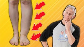 How To Fix Foot amp Ankle Swelling Everything You Need To Know [upl. by Telracs550]