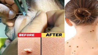 warts removal treatment and heading processموہکوں کا جڑھ سے خاتمہ [upl. by Saretta]