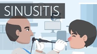 What is Sinusitis [upl. by Rourke]