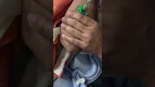 18G Iv Cannulation 🩸💉nursing doctor hospital trending ytshorts reels viralvideo yt [upl. by Nyrhtak799]