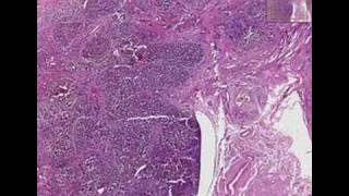 Histopathology LiverPrimary biliary cirrhosis [upl. by Jon]