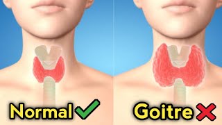 goitre disease treatment  causes treatment and symptoms of goitregoiter thyroid gland [upl. by Ahsineg143]