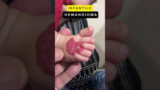 Infantile Hemangioma hemangioma infants treatment [upl. by Nomma]