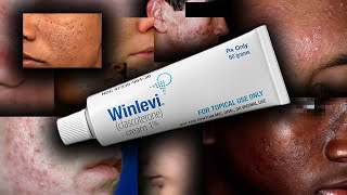 Dont use Accutane Use Winlevi for acne [upl. by Bibah]