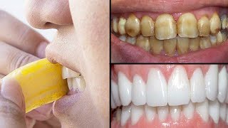 Teeth Whitening At Home In Just 2 Minutes Home Remedies [upl. by Nahtam]