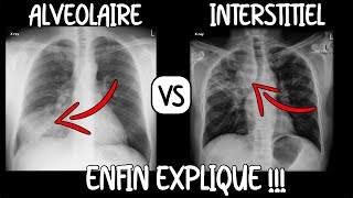 Médecine  Tout savoir sur la radiographie de thorax [upl. by Reseda]