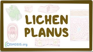 Lichen planus  causes symptoms diagnosis treatment pathology [upl. by Prasad]