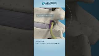 Lumbar Lateral Stenosis Shorts ​Atlantic Spine Center [upl. by Bax]