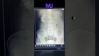 Intra venous urogram  pyelogram  radiological xray medicalimaging doctor anatomy [upl. by Anika]