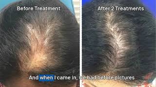 Hair Loss Treatment for Men amp Women TED Hair Ultrasound Demo [upl. by Arlena]