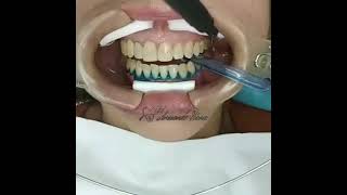 blanqueamiento dental [upl. by Kimberly888]