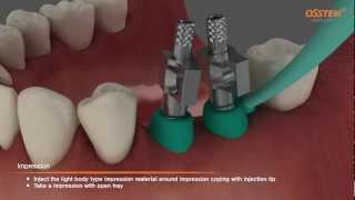 TSIII Fixture Placement amp Impression taking Pickup and Transfer Impression Copings [upl. by Sallie]