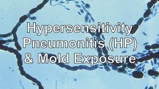 Hypersensitivity Pneumonitis amp Mold Exposure [upl. by Thorma35]