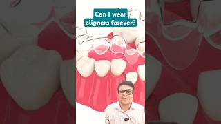 Can I wear Aligners forever [upl. by Feldstein983]