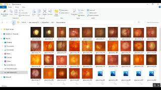 Fuzzy acceptance Analysis of Impact of Glaucoma and Diabetic Retinopathy using Confusion Matrix [upl. by Inavoig]