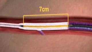 The VNUS Closure Procedure Using ClosureFAST Catheter [upl. by Calvo]