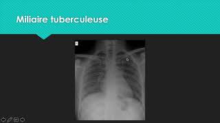 M2 Analyse de la radiographie thoracique parenchyme [upl. by Rhodie]