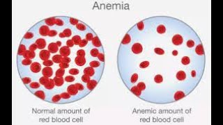 🔴Types of Anemia DrHazem Sayed [upl. by Prescott]