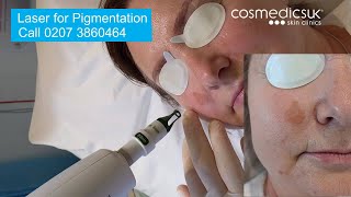 Laser for facial pigmentation amp sun damage treatment demo  see before and after results [upl. by Nail]