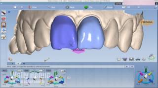 Planscan veneers [upl. by Niassuh]