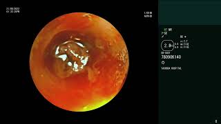 Pulmonary Mucormycosis  Massive hemoptysis  Bronchoscopy [upl. by Kyl]