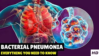 Bacterial Pneumonia – Causes Signs and Symptoms Diagnosis amp Treatment [upl. by Omle546]