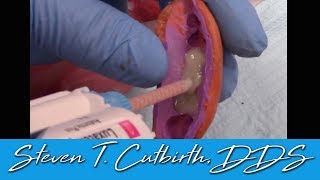 Temporary Crowns Quick and Easy Fabrication  Dental Minute with Steven T Cutbirth DDS [upl. by Tonkin]