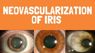 Causes of Neovascularization of iris  Rubeosis iridis  Ocular signs [upl. by Ocirderf]