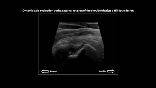 HillSachs fracture on shoulder ultrasound [upl. by Wilhelmina177]