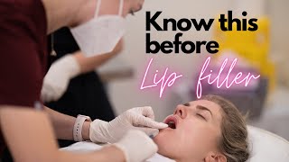 5 things to know before getting lip filler [upl. by Dino]