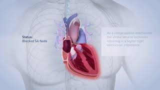 Biotronik pacemaker [upl. by Naejamron629]