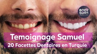 SOINS DENTAIRES EN TURQUIE  🦷 Témoignage de Samuel  20 facettes dentaires Emax  BODYEXPERT [upl. by Dennet480]