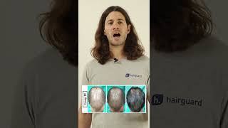 Minoxidil Gains  Boost its POWER  Part 2 Spironolactone for hair loss [upl. by Bearce]