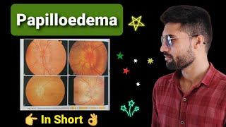 Papilloedema lecture opthalmology [upl. by Laurena906]