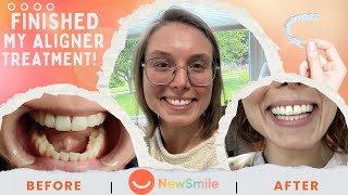 The Result Of My NewSmile Aligner Journey  Customer Honest Review [upl. by Ednalrim]