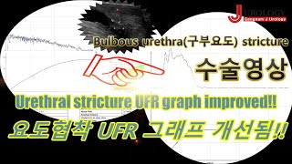 홀뮴레이저를 이용한 구부요도협착 수술로 요속그래프 개선되었습니다 Holmium laser bulbourethral surgery improved UFR graph [upl. by Midge]