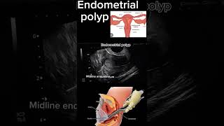 Endometrial Polyp Case Study A StepbyStep Diagnosis health ultrasound polyp DrSaimakhan [upl. by Anivlek]