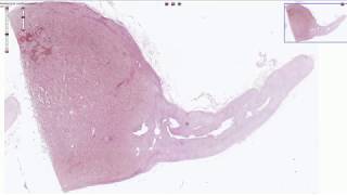 Pheochromocytoma  Histopathology [upl. by Langsdon173]