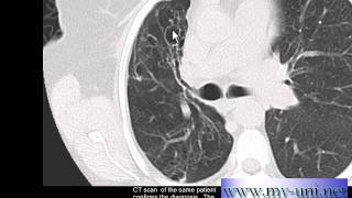 Chest xray Bronchiectasis on CT and Chest xray [upl. by Avert456]