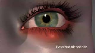 What is Blepharitis amp How to treat it [upl. by Nov]